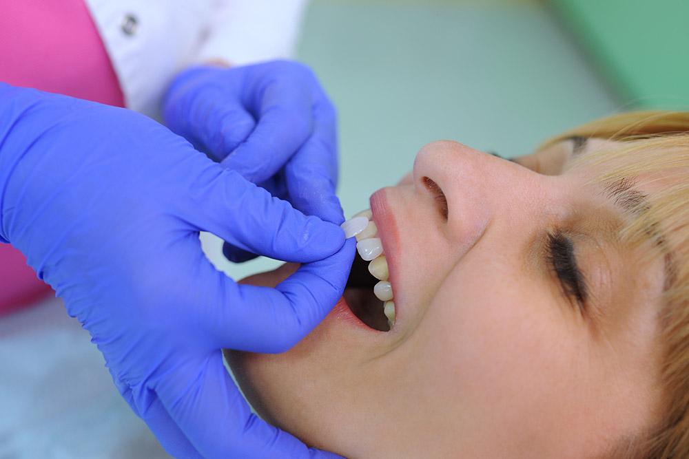 veneers